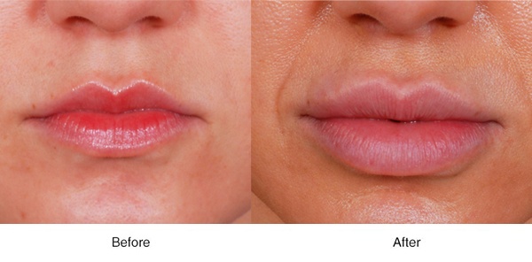 Plump Lips - Boss MD Plastic Surgery - Bergen County NJ Oro Medspa