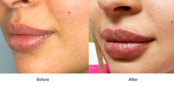 Lip Fillers - Boss MD Plastic Surgery - Bergen County NJ