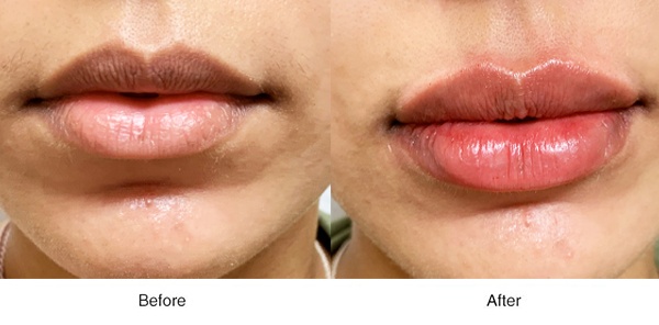 Plump Lips - Boss MD Plastic Surgery - Bergen County NJ