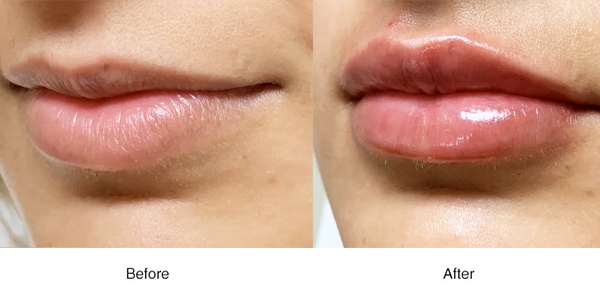 Plump Lips - Boss MD Plastic Surgery - Bergen County NJ Oro Medspa