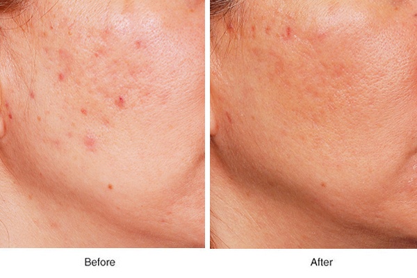 Acne Scar Rejuvenation - Boss MD Plastic Surgery Bergen County NJ