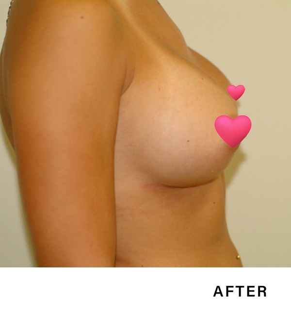 breast augmentation nj