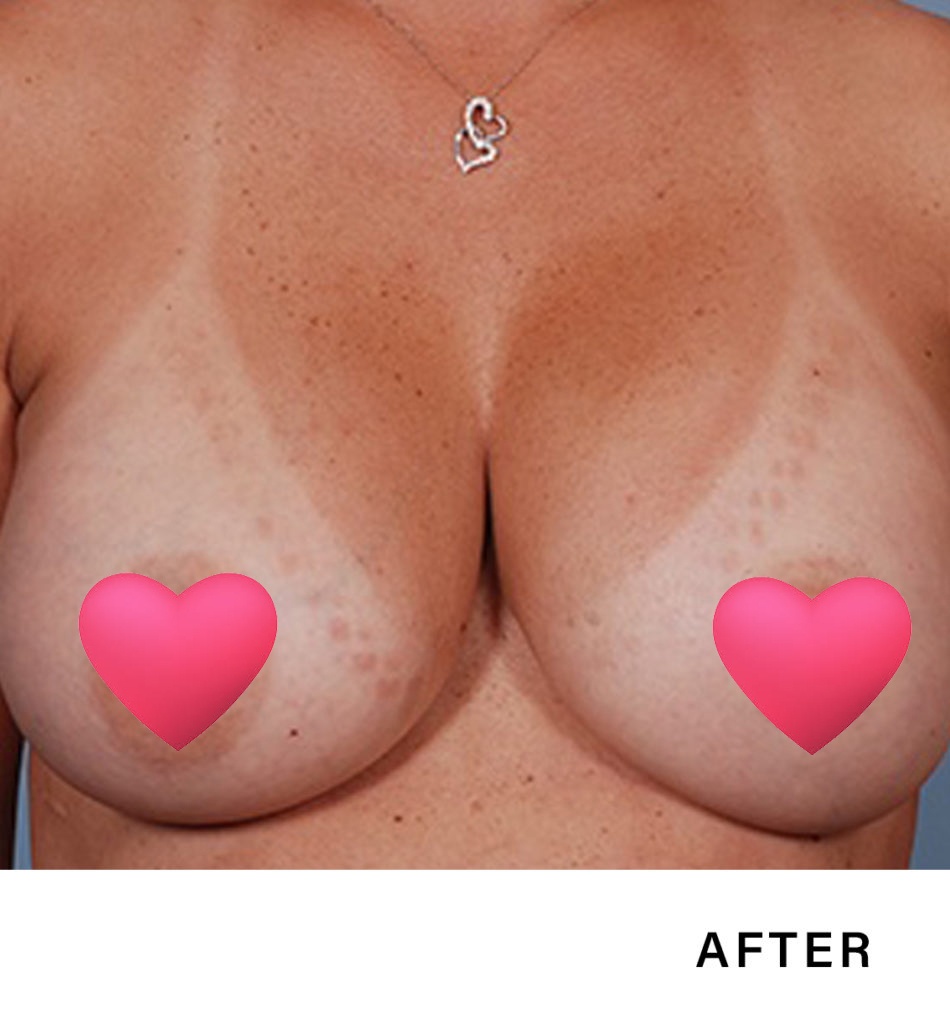 beast augmentation – boss md plastic surgery bergen county nj 1 breast augmentation - boss md plastic surgery - bergen county nj