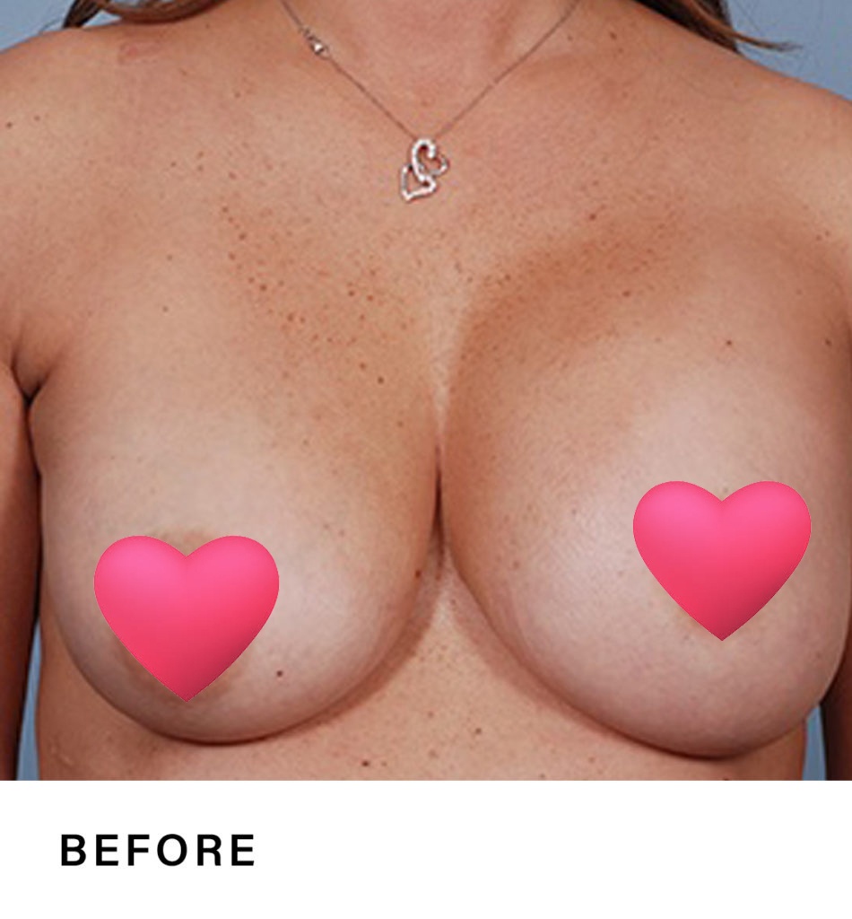 beast augmentation – boss md plastic surgery bergen county nj 2 breast augmentation - boss md plastic surgery - bergen county nj