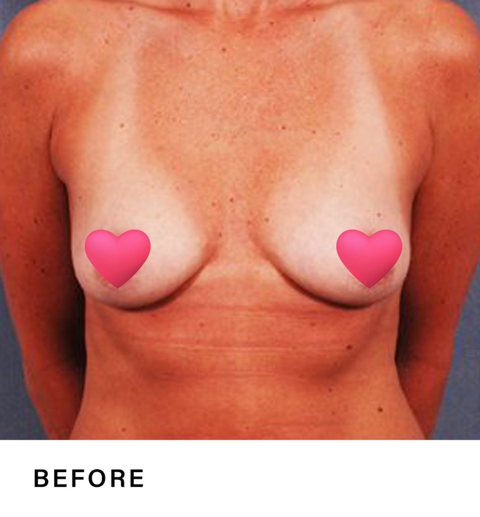 breast augmentation nj