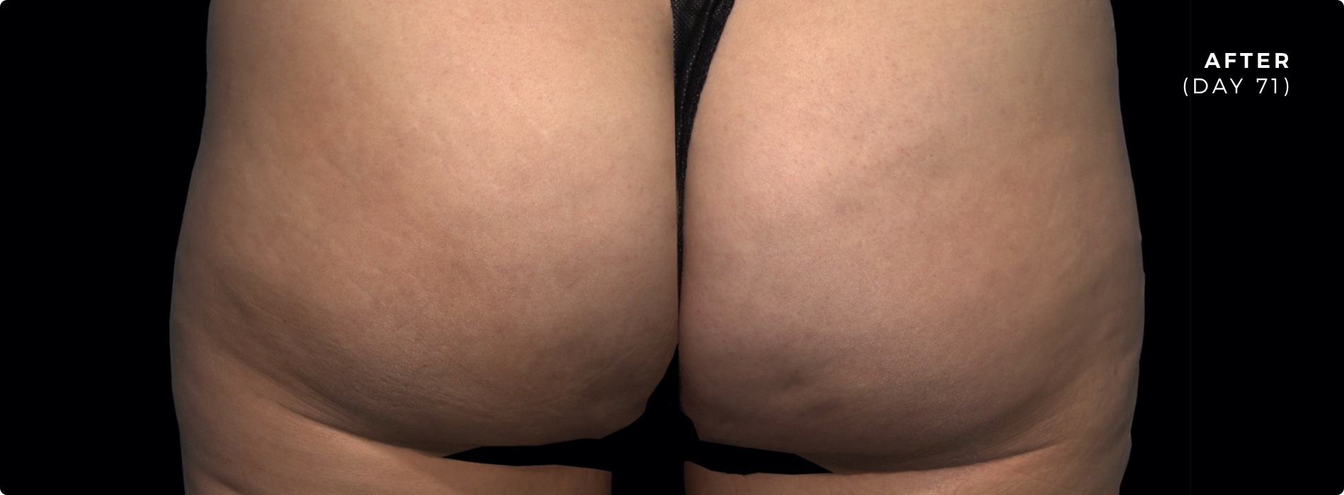  qwo cellulite treatment injections - boss md plastic surgery - bergen county nj