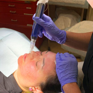 microneedling - boss md plastic surgery - bergen county