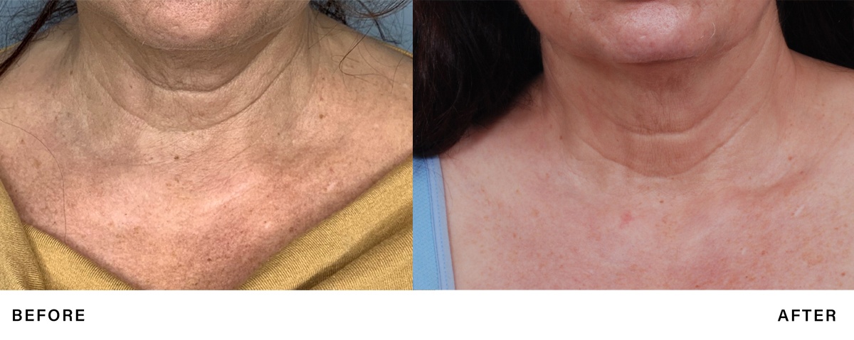morpheus8 skin rejuvenation- boss md plastic surgery - treatment results
