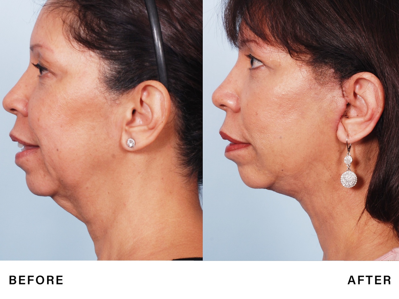 neck tightening – genlyft – bossmd plastic surgery nj 2 neck tightening - genlyft - bossmd plastic surgery nj