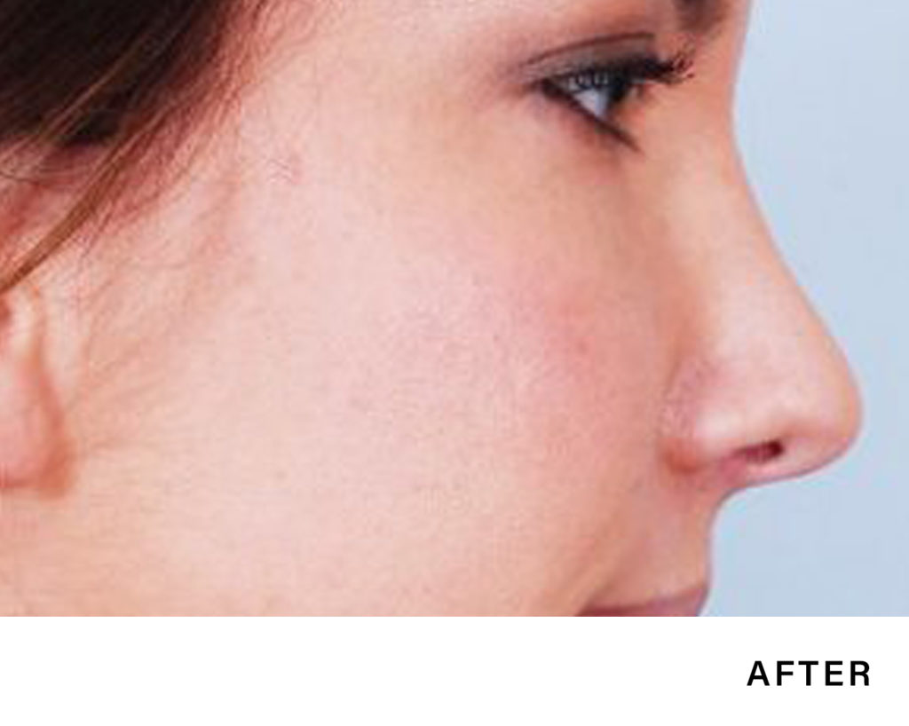 nj rhinoplasty – Boss MD Plastic Surgery nj rhinoplasty - Boss MD Plastic Surgery