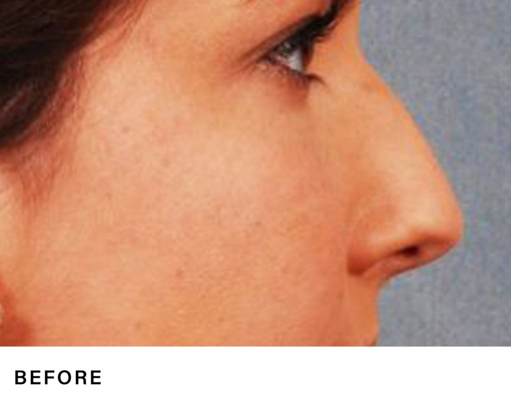 nj rhinoplasty – Boss MD Plastic Surgery nj rhinoplasty - Boss MD Plastic Surgery