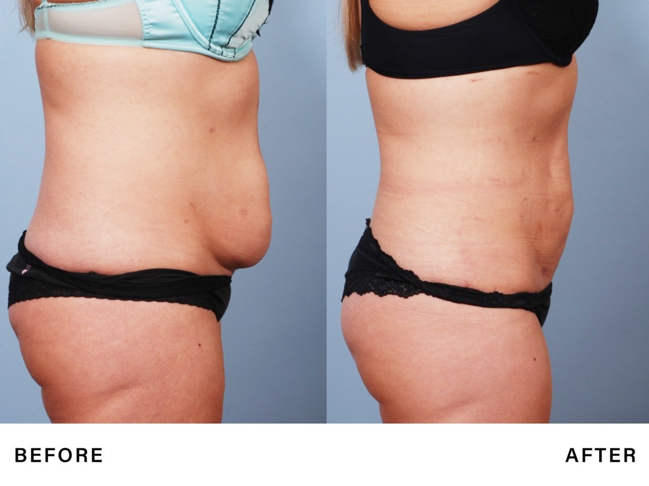 rfal laser fat reduction – genlyft body – bossmd plastic surgery nj -3 laser fat reduction - boss md plastic surgery - bergen county nj