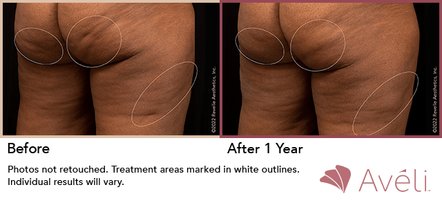 aveli cellulite treatment - aveli nj - avelli cellulite procedure - cellulite reduction nj