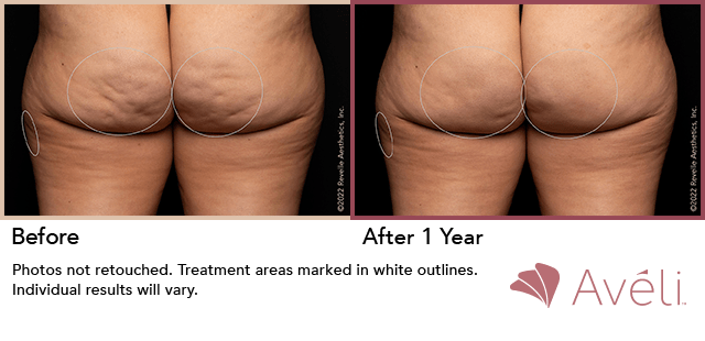 avelli cellulite procedure - cellulite reduction nj