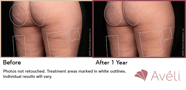 avellli cellulite procedure - cellulite reduction nj