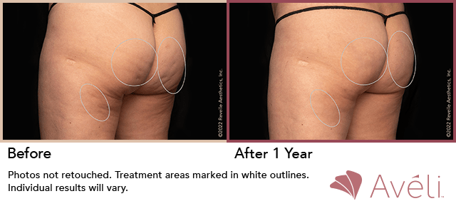 aveli nj - before and after