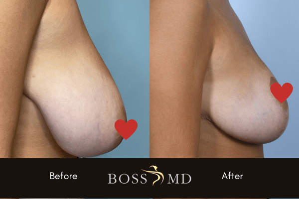 drbossmdbreastreduct